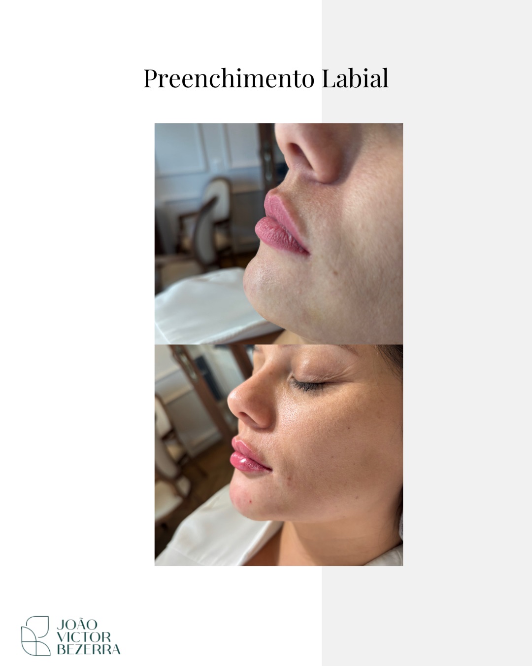 Harmonização Facial Injetáveis