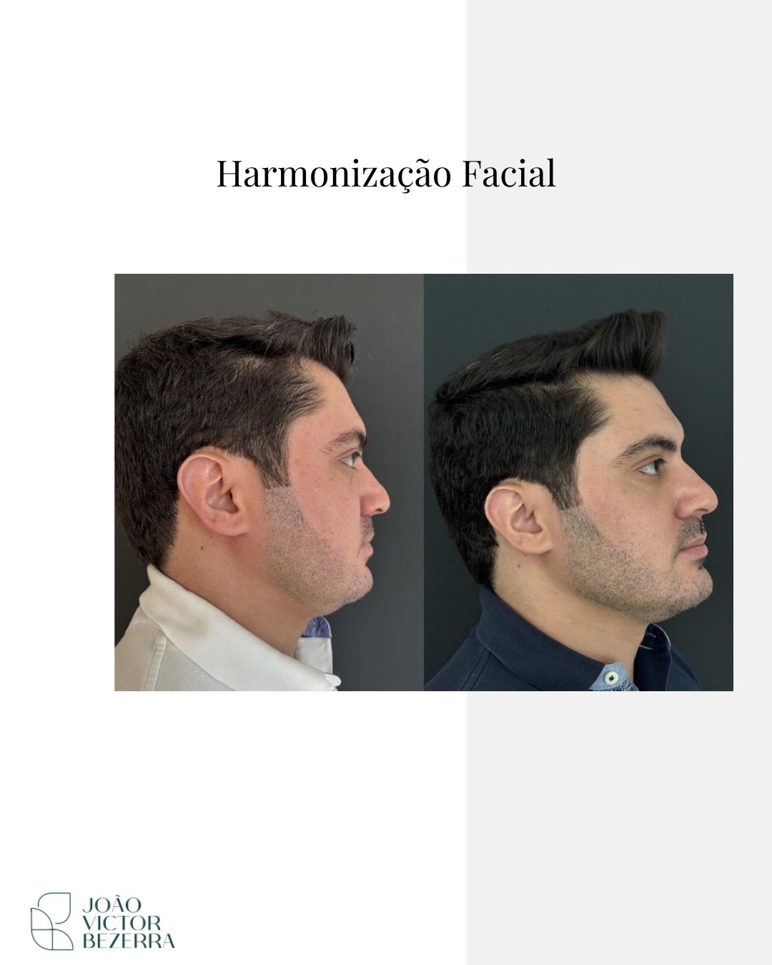 Harmonização Facial Injetáveis
