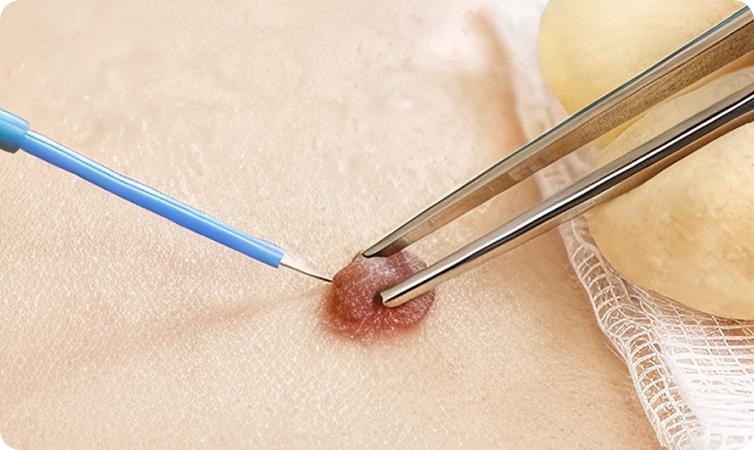 Cirurgias Dermatológicas