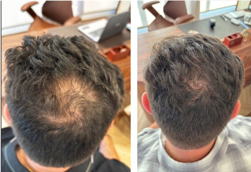 Antes e depois - Tratamento de queda capilar masculino