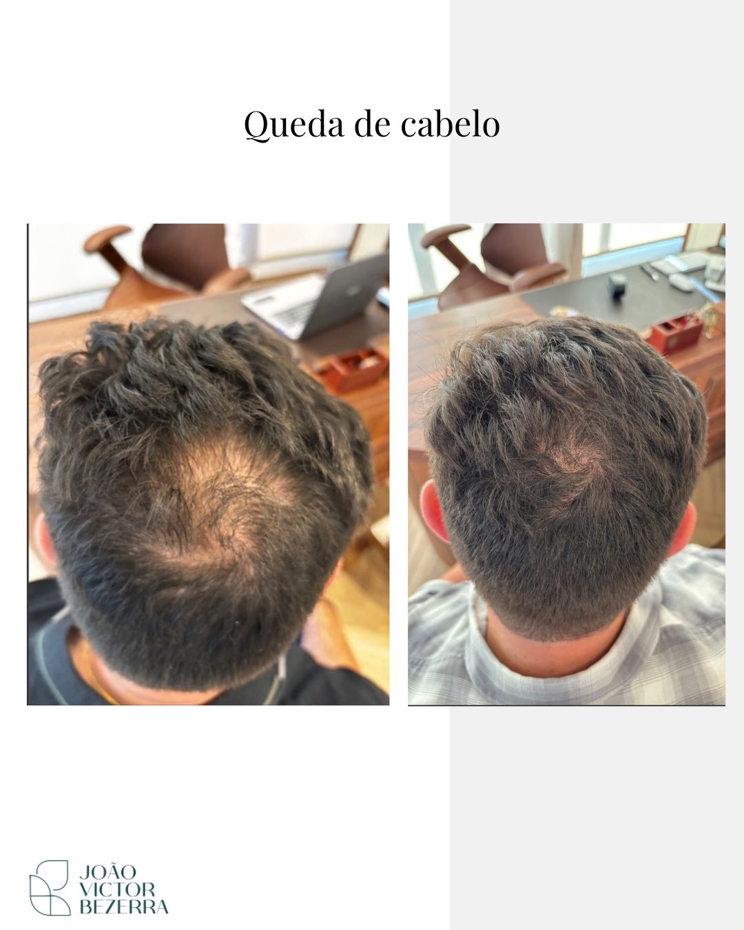 Tratamento da Queda Capilar