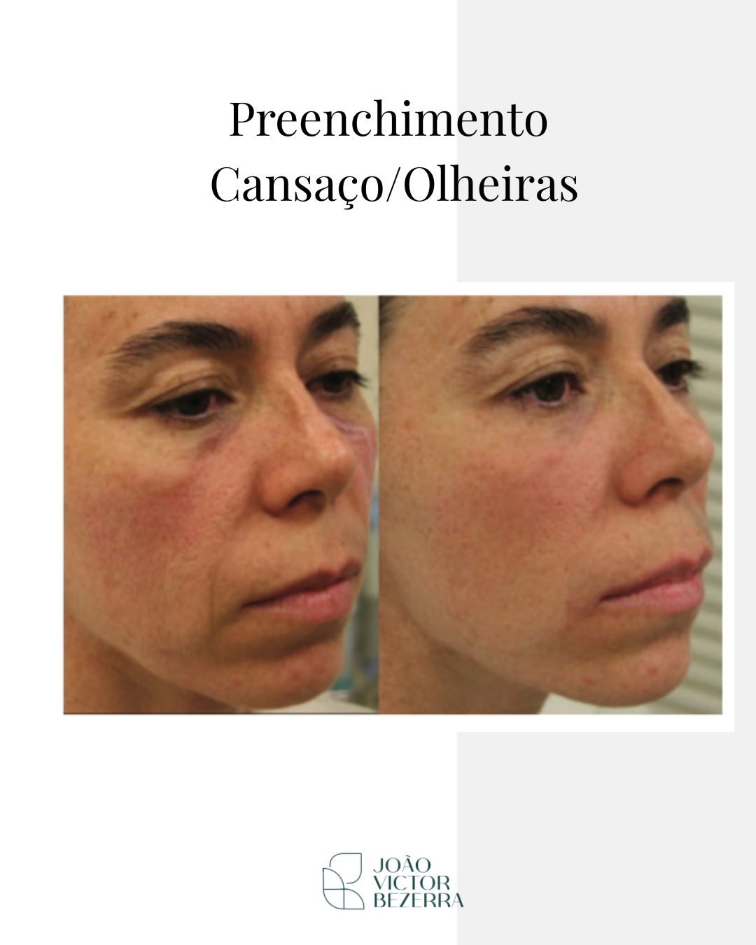 Harmonização Facial Injetáveis