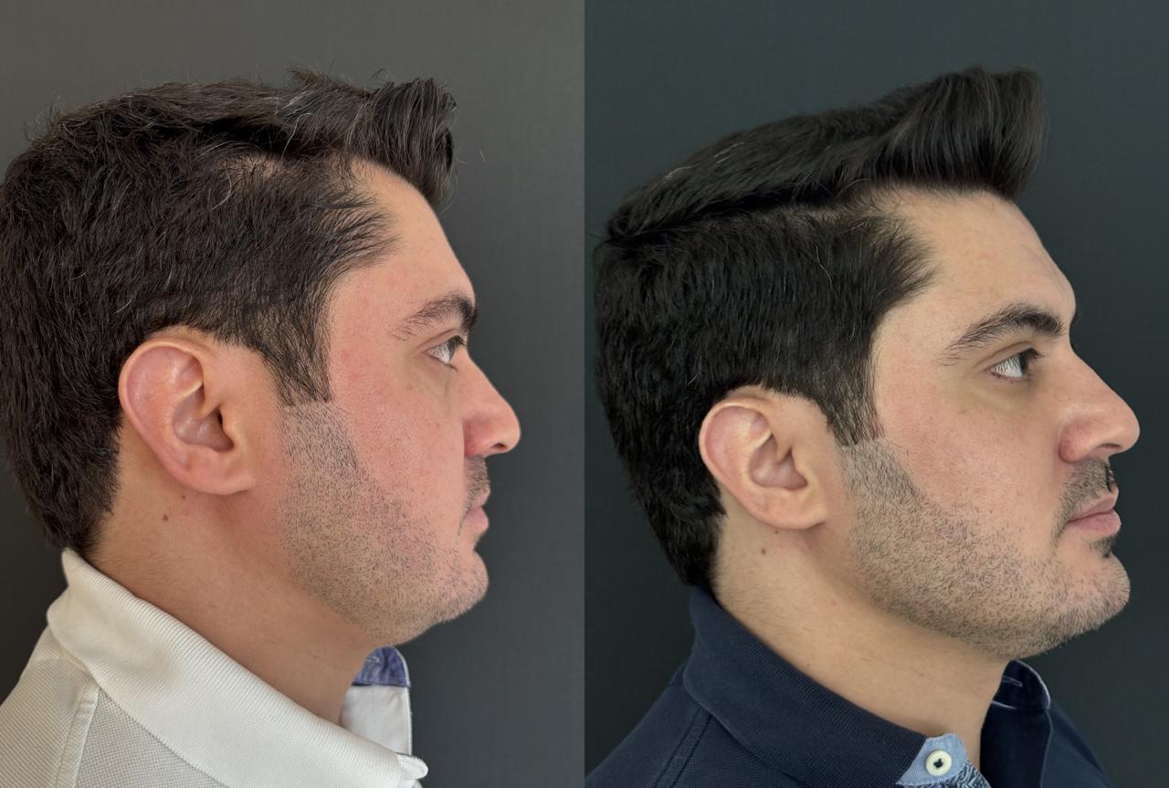 Antes e depois - Harmonização Facial