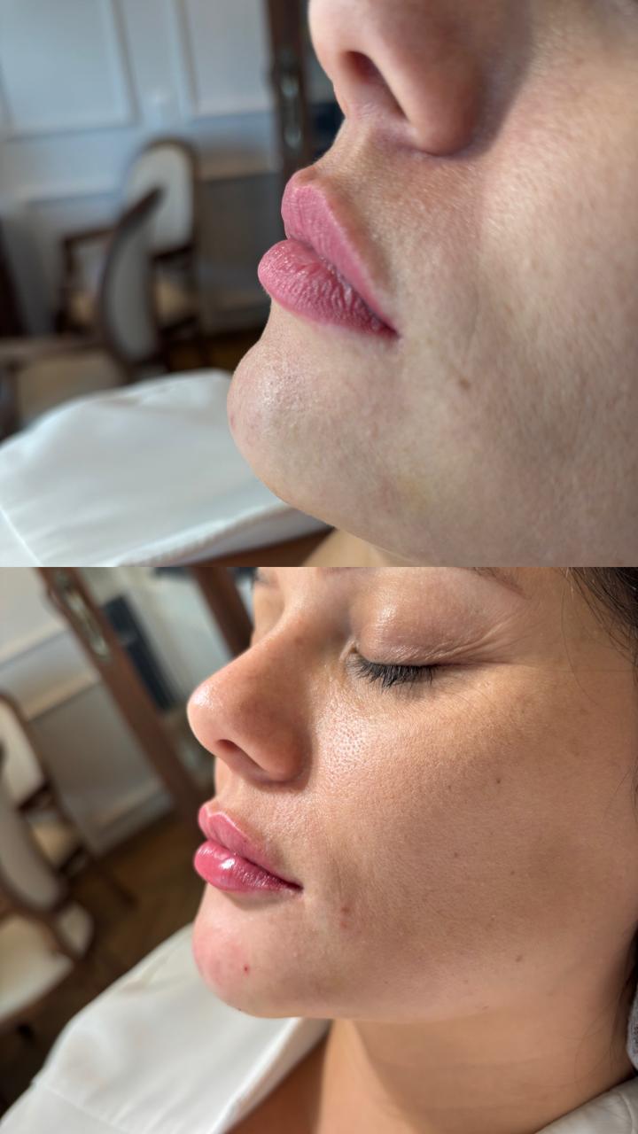 Perfil dos lábios antes e depois do preenchimento labial