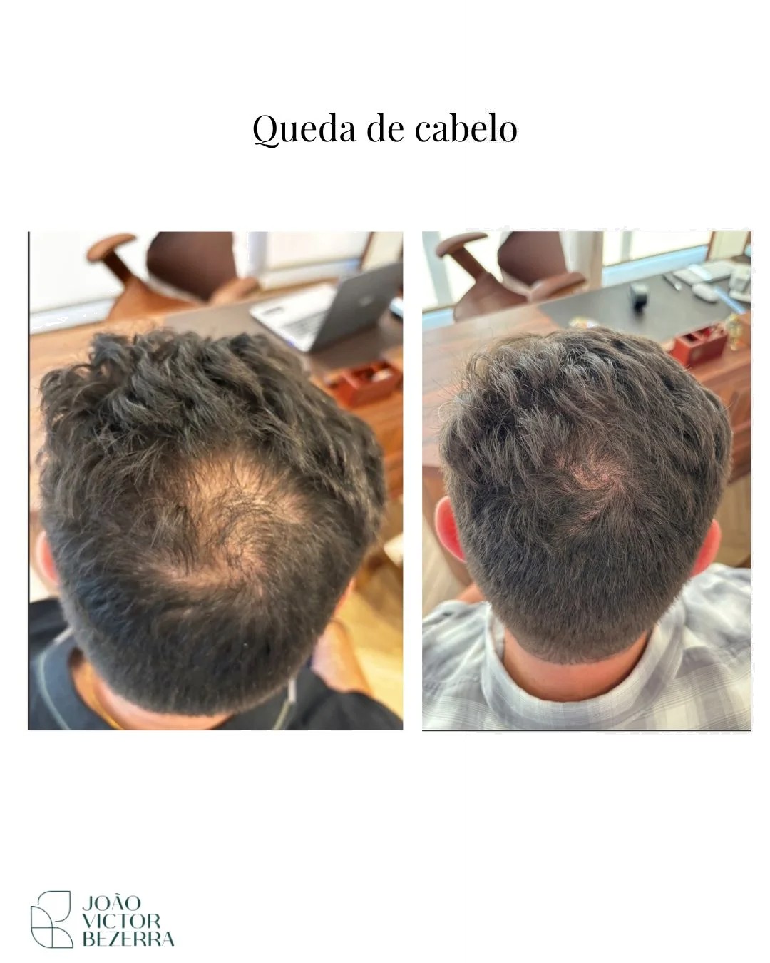 Antes e depois - Tratamento de queda capilar masculino