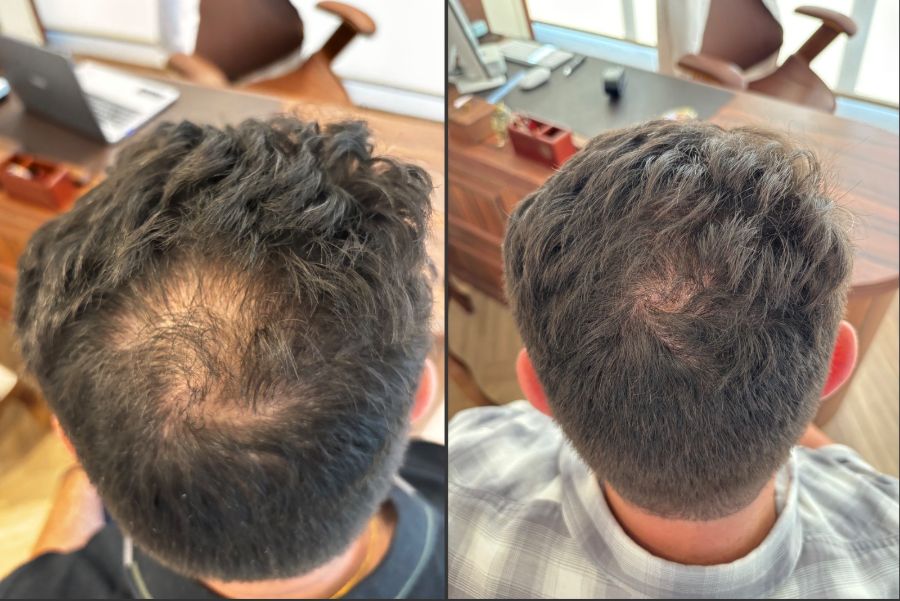 Couro cabeludo antes e depois do tratamento de queda capilar