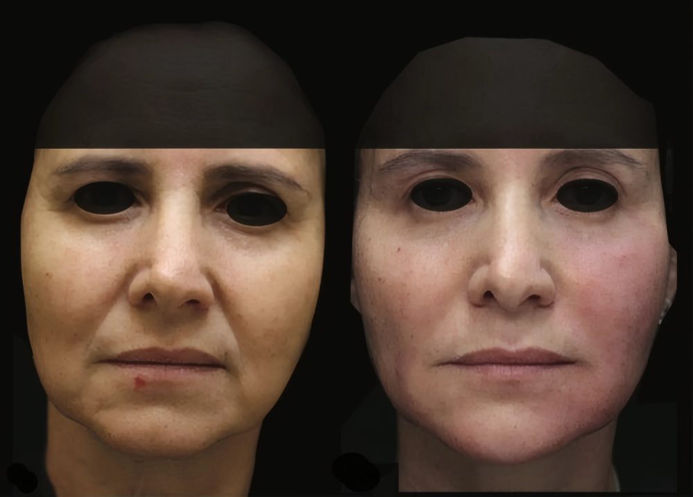 Rosto de frente antes e depois do tratamento de flacidez e bigode chinês