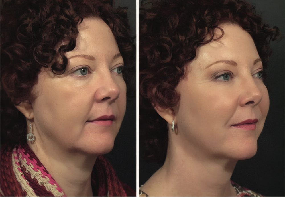 Perfil do rosto antes e depois do tratamento de bigode chinês e flacidez