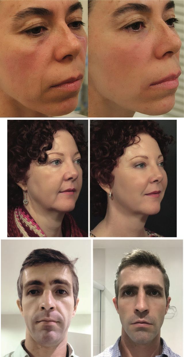 Registros de antes e depois de tratamentos de rejuvenescimento facial