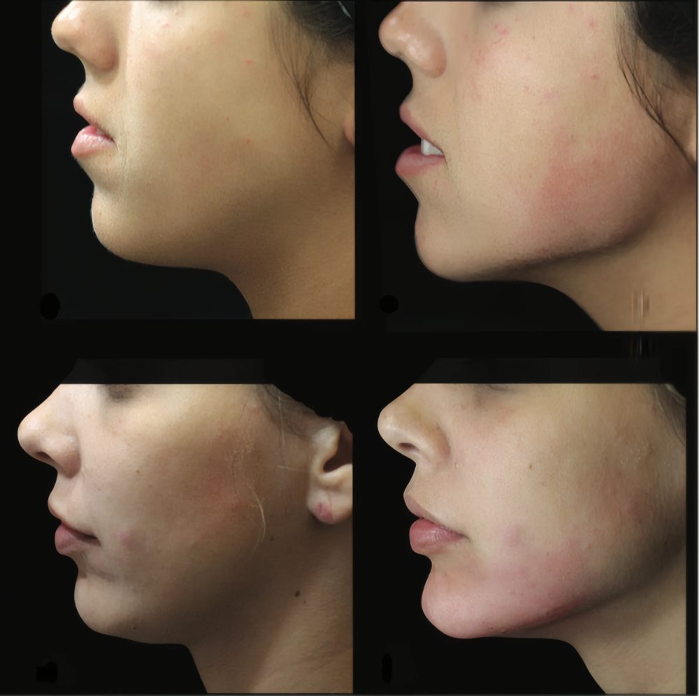 Perfil do queixo e da mandíbula antes e depois do preenchimento do terço inferior