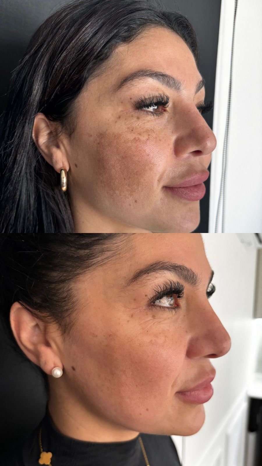 Antes e depois - Tratamento de Melasma