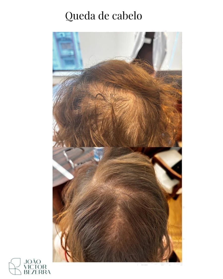 Antes e depois - Tratamento de queda capilar feminino