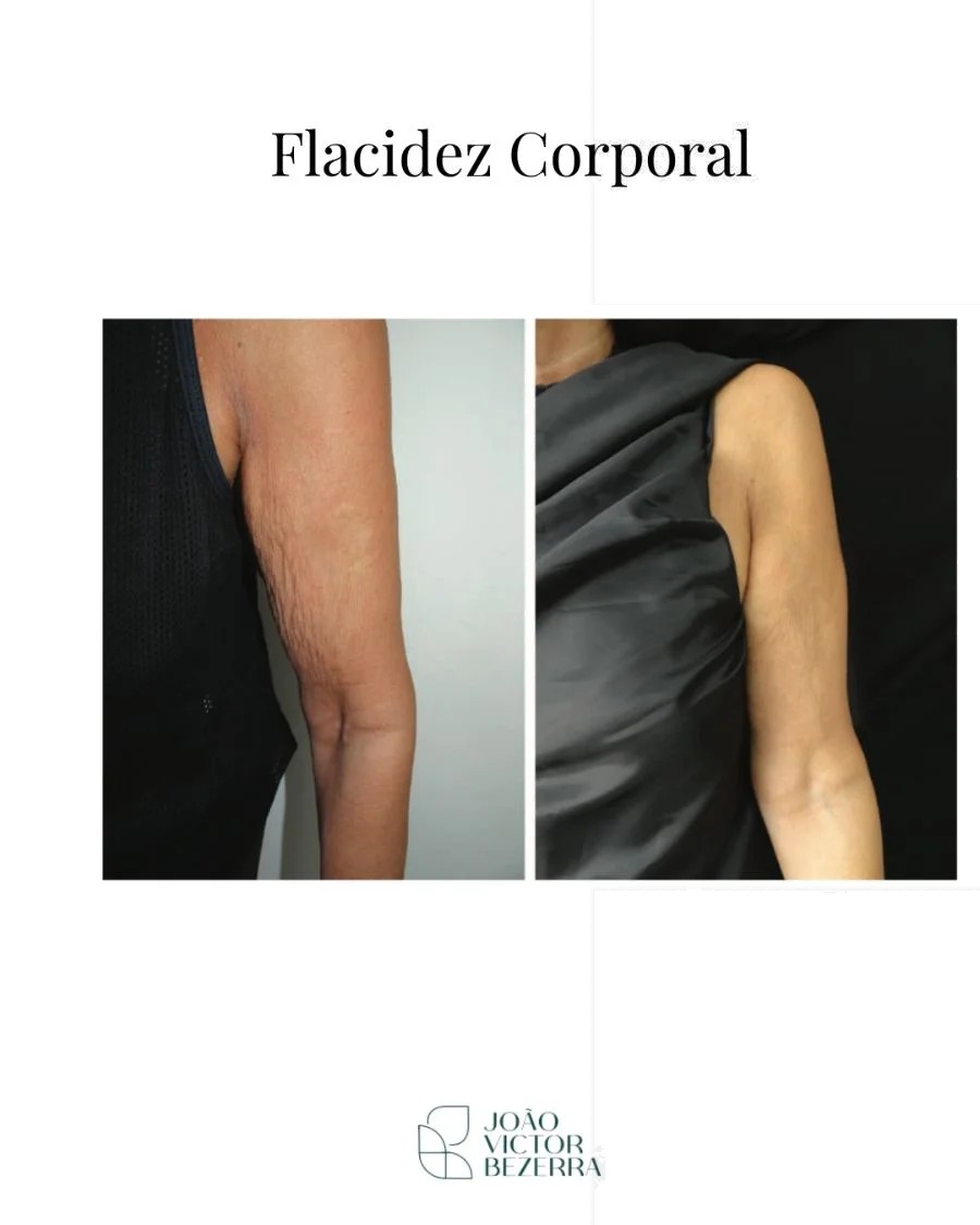 Flacidez corporal no braço antes e depois do bioestimulador de colágeno