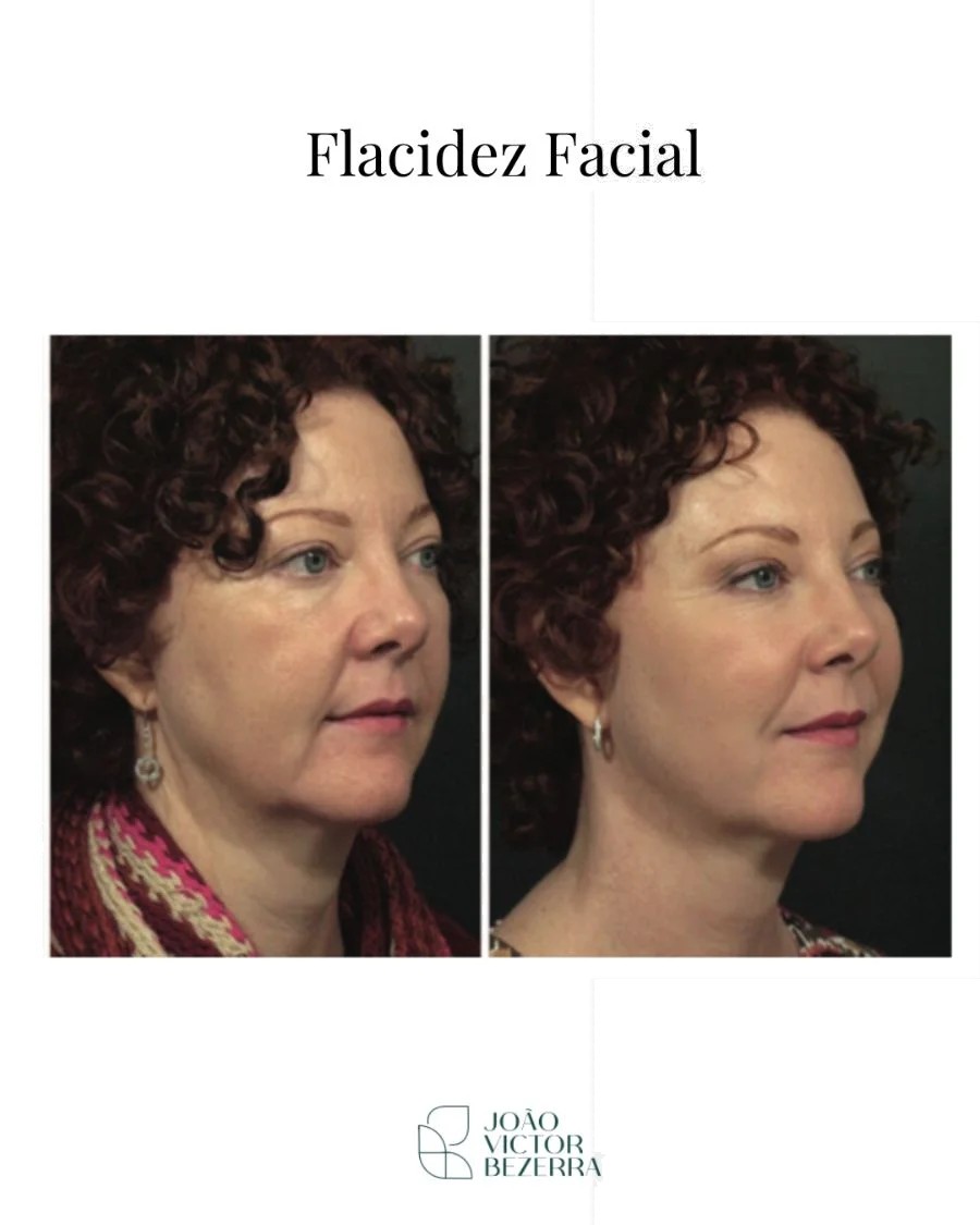 Flacidez facial antes e depois do bioestimulador de colágeno