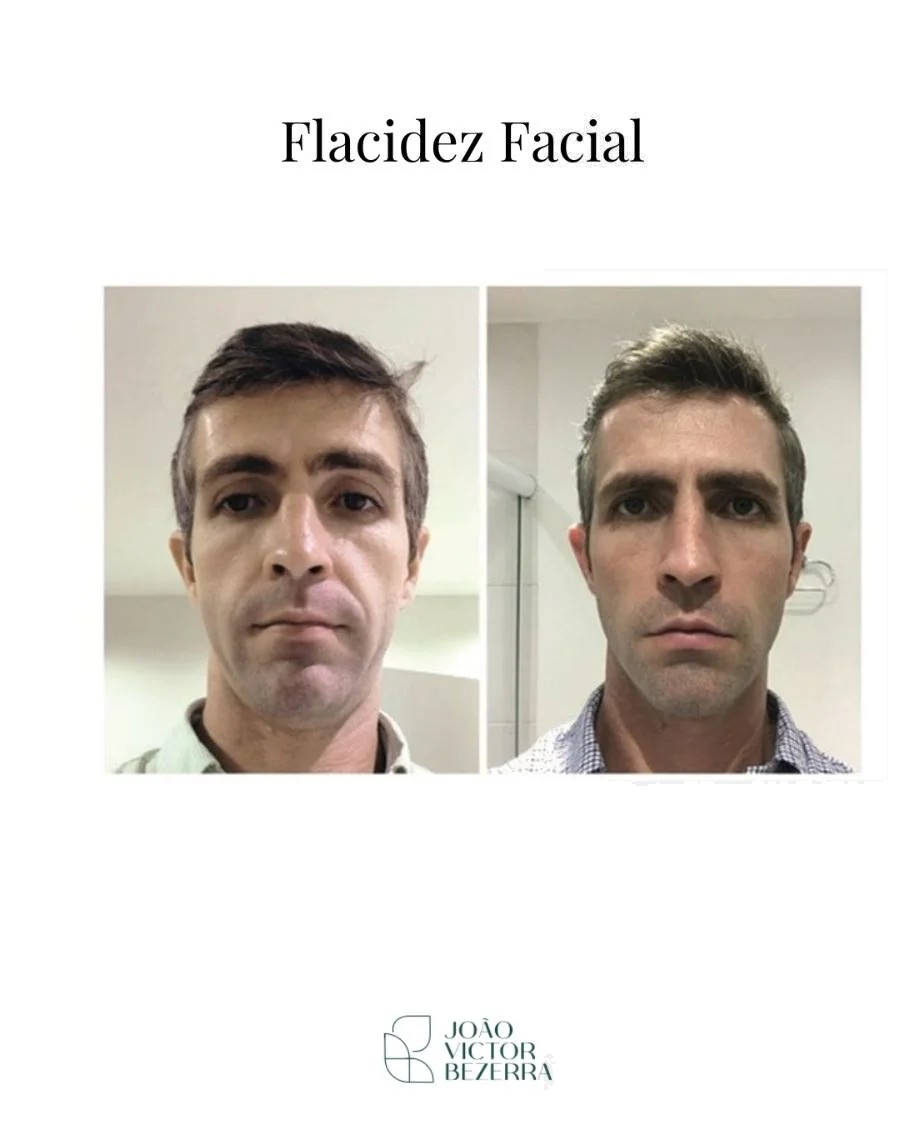 Flacidez facial antes e depois do bioestimulador de colágeno
