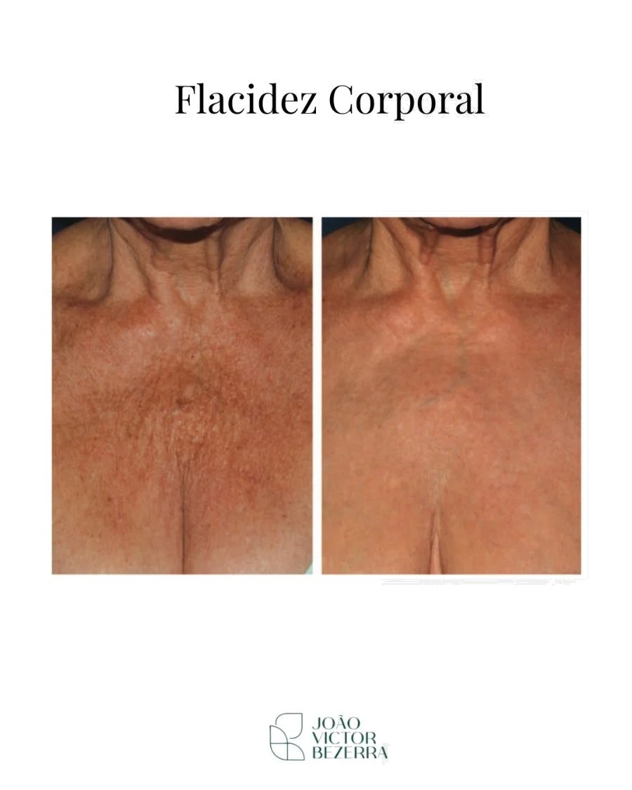 Flacidez facial antes e depois do bioestimulador de colágeno