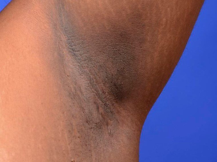 Na axila: pele mais escura e aveludada na dobra