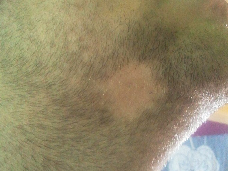 Na barba: a mesma falha pode surgir nos pelos do rosto