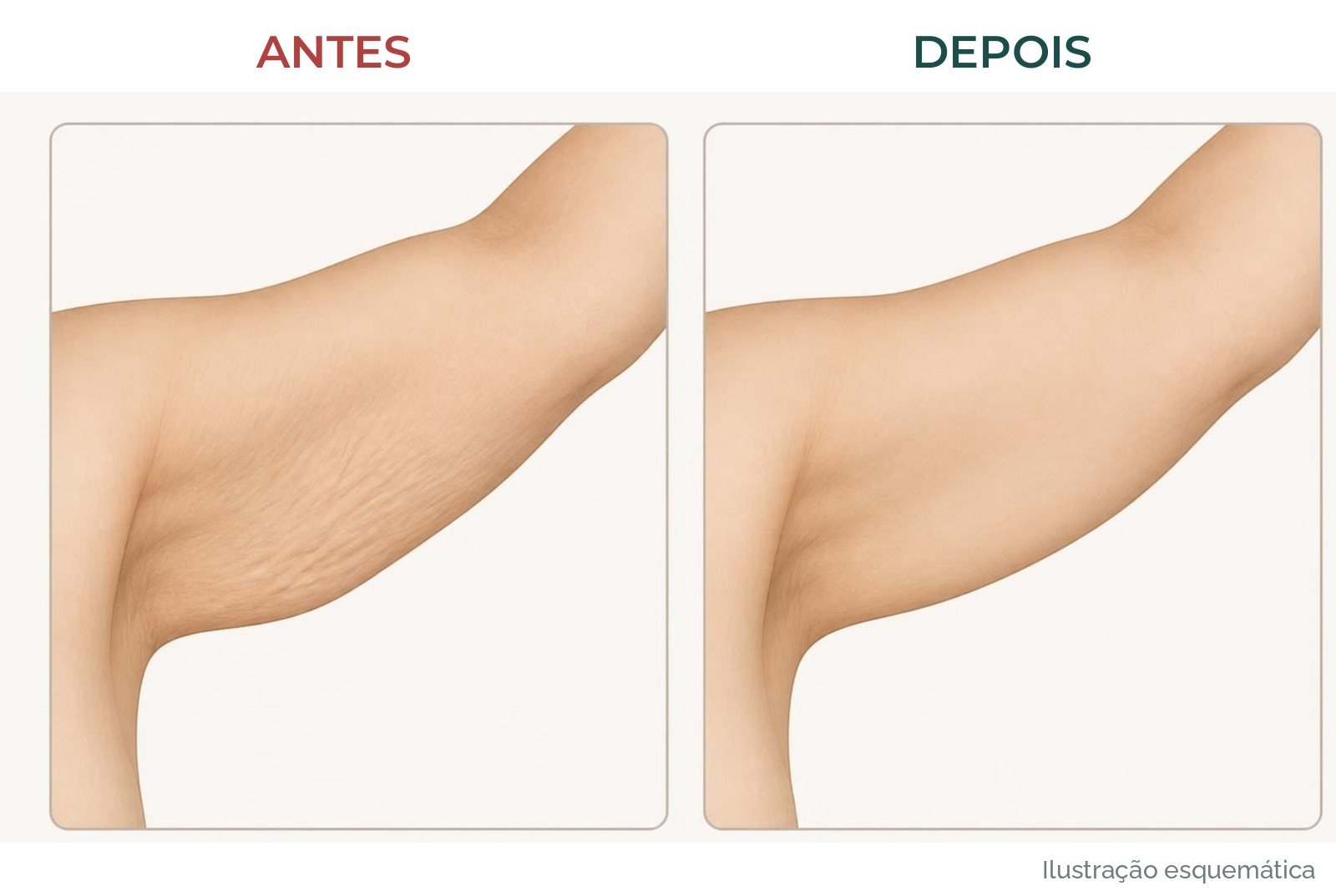 Ilustração esquemática de antes e depois da parte interna do braço: pele fina e enrugada antes, mais lisa e firme depois