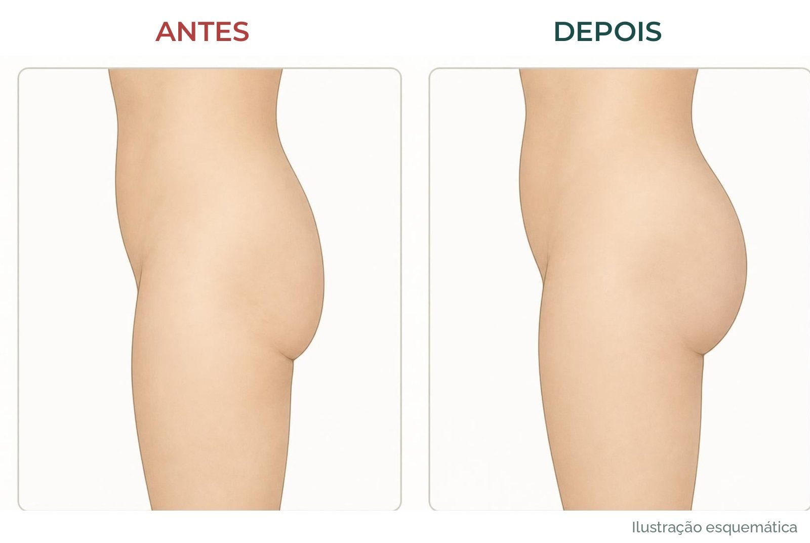 Ilustração esquemática de antes e depois do glúteo visto de lado: mais baixo e com menos firmeza antes, contorno mais firme depois
