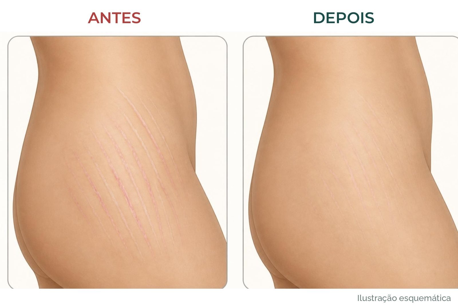 Ilustração esquemática de antes e depois de estrias no quadril: estrias rosadas antes e mais claras e finas depois, ainda visíveis