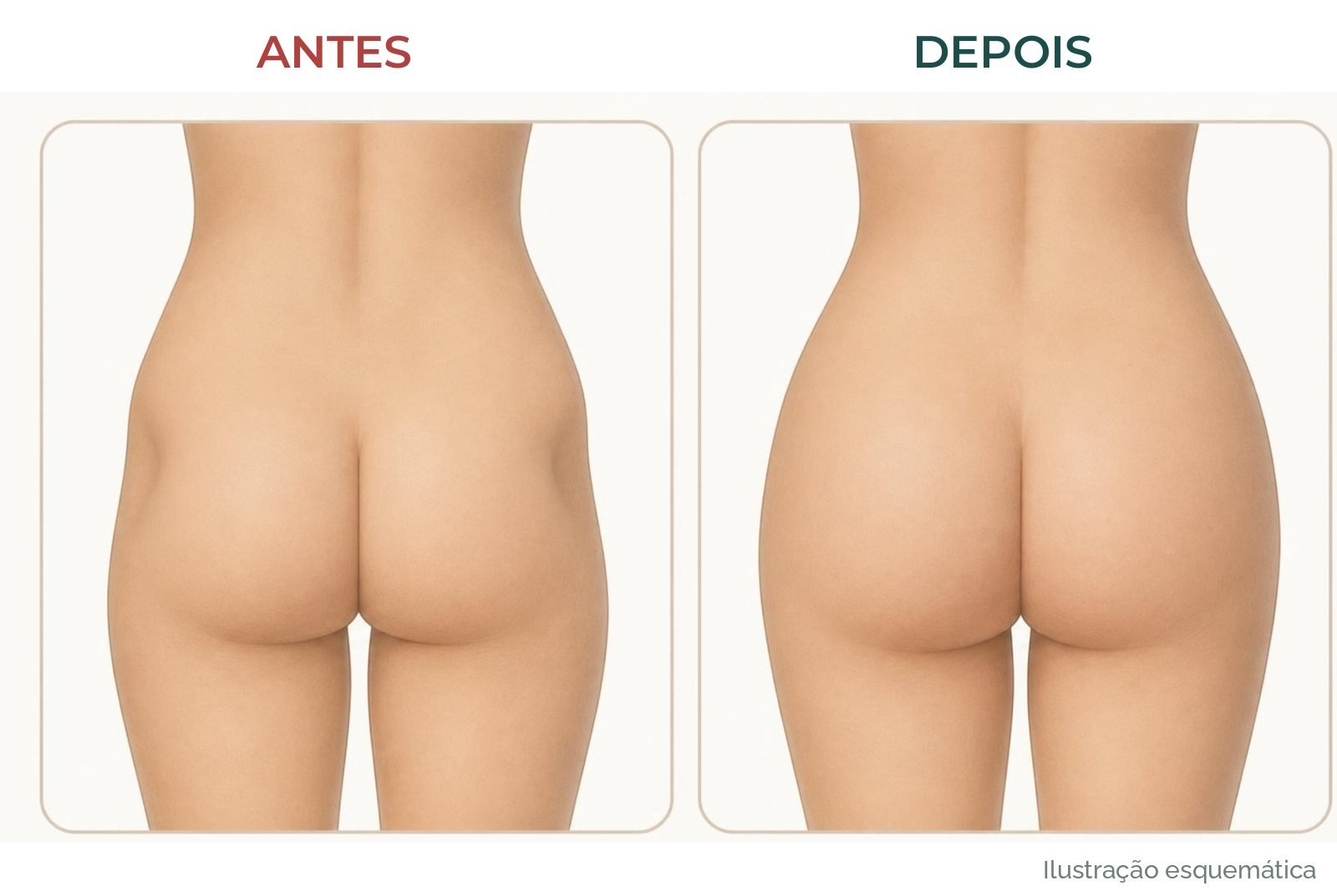 Ilustração esquemática de antes e depois do glúteo visto de trás: contorno mais plano antes e mais arredondado depois