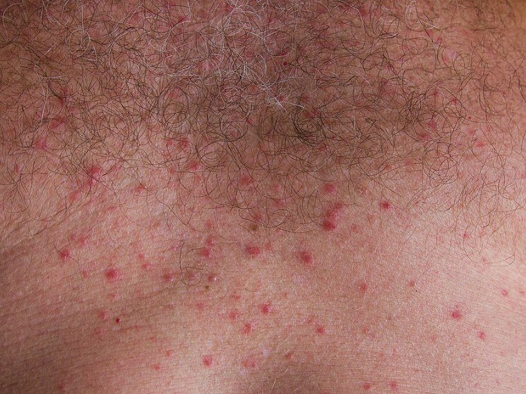 Brotoeja vermelha: pontos vermelhos em área de suor, como o peito