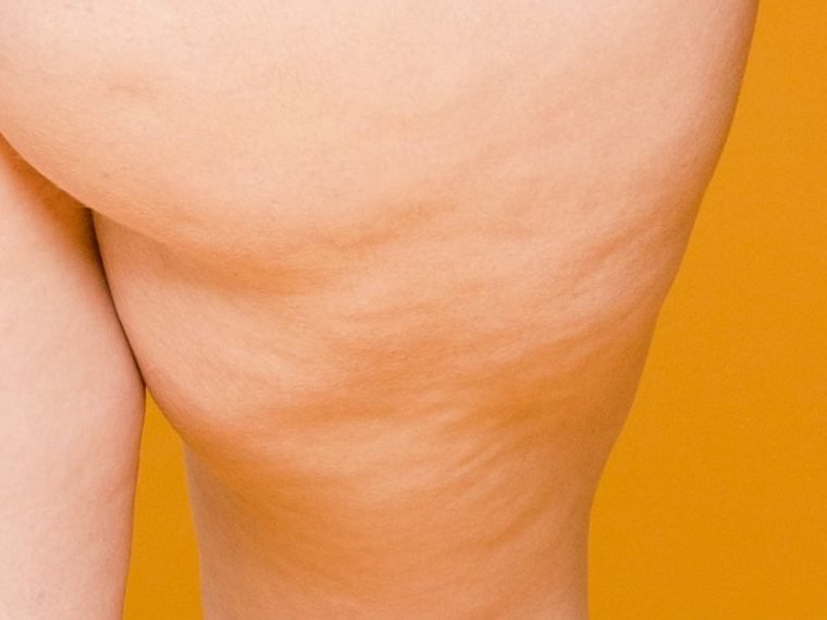 Celulite mais leve, com ondulação discreta abaixo do glúteo