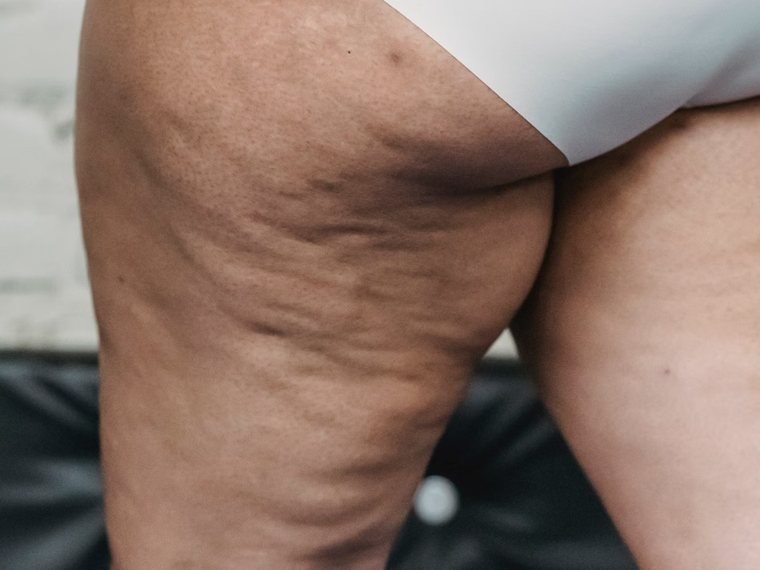 Celulite mais marcada, com covinhas e depressões na parte de trás da coxa