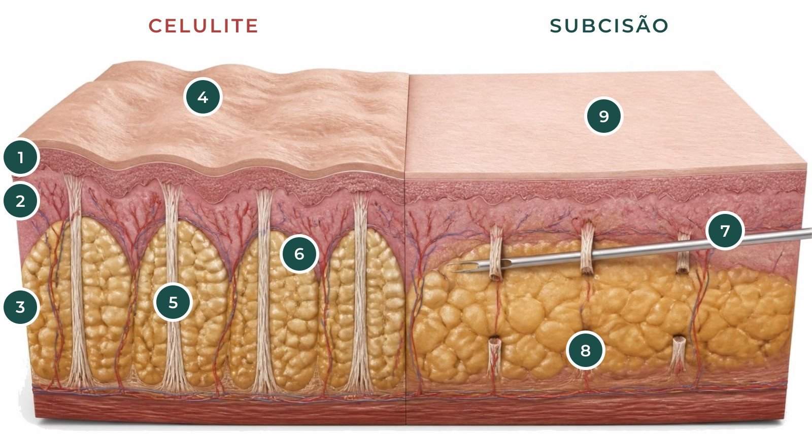 Ilustração em corte da pele com pinos numerados: septos fibrosos que formam as covinhas da celulite e a subcisão cortando esses septos