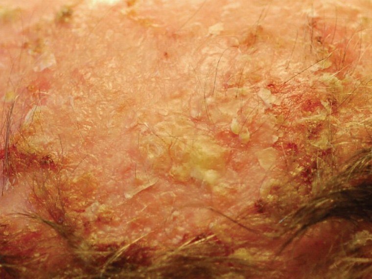 Ceratose actínica: áspera, avermelhada, em pele com muito sol