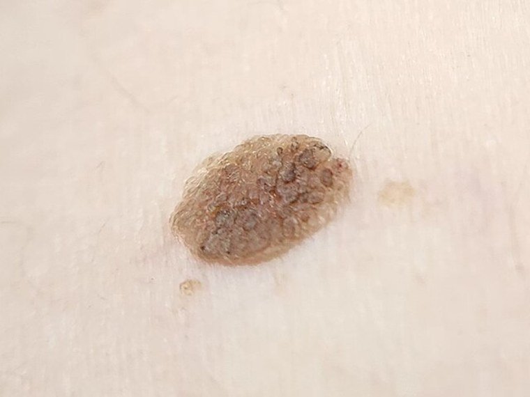 Ceratose seborreica: marrom e saliente, parece colada na pele