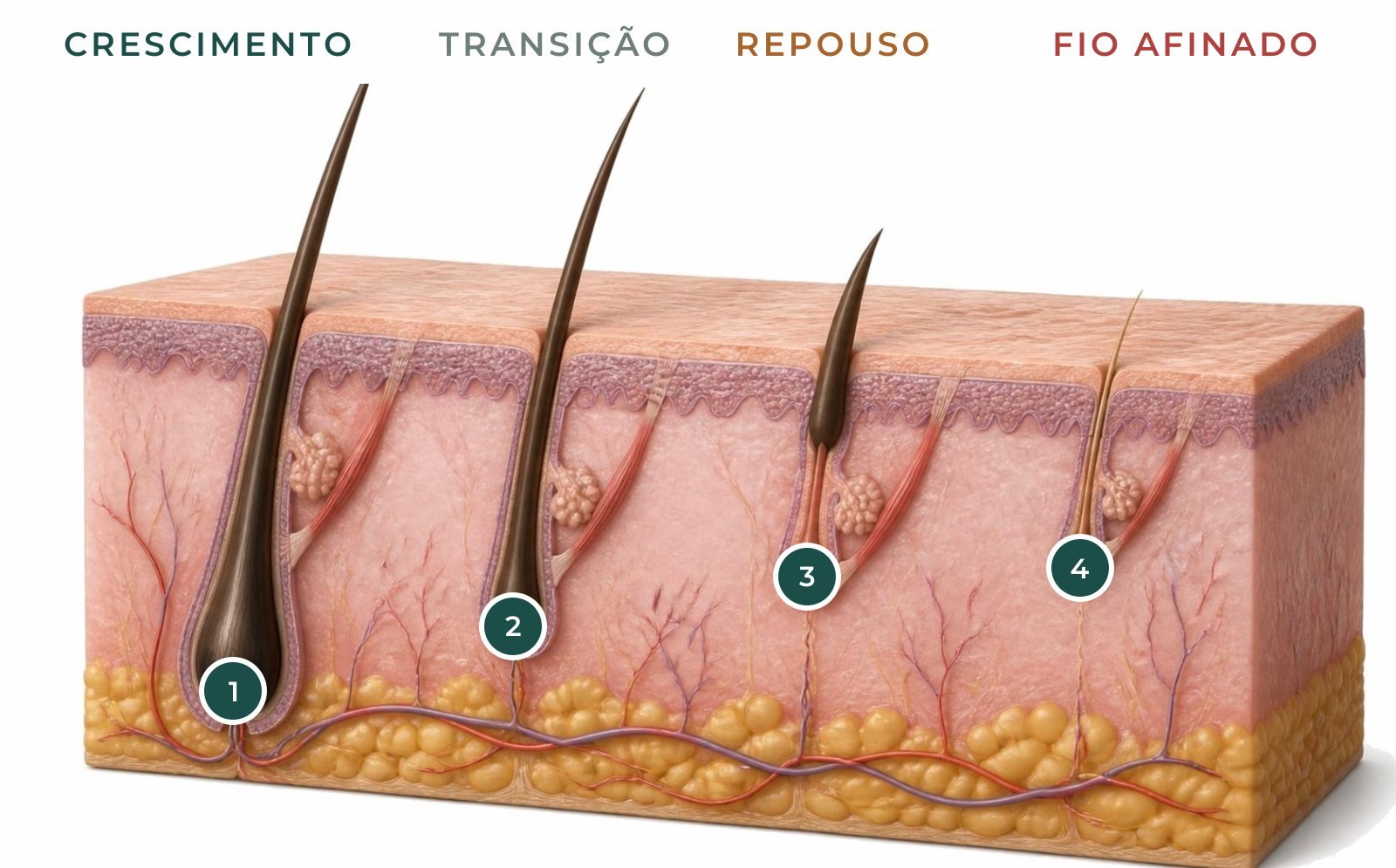 Ilustração em corte do couro cabeludo com quatro folículos: crescimento, transição, repouso e fio afinado