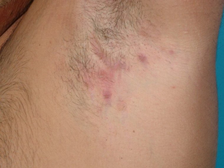 Na axila: nódulos e inflamação que voltam no mesmo lugar