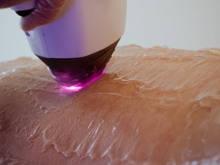 O laser: parâmetros ajustados à pele de cada um
