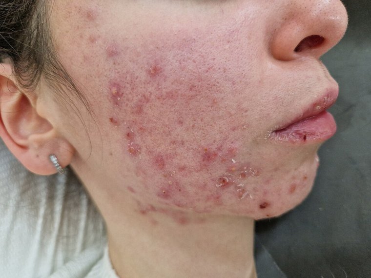 Marcas de acne: textura e manchas que ficam depois