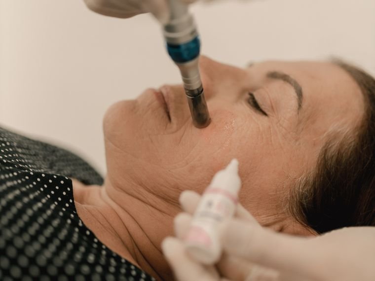 O microagulhamento: microlesões que estimulam a pele