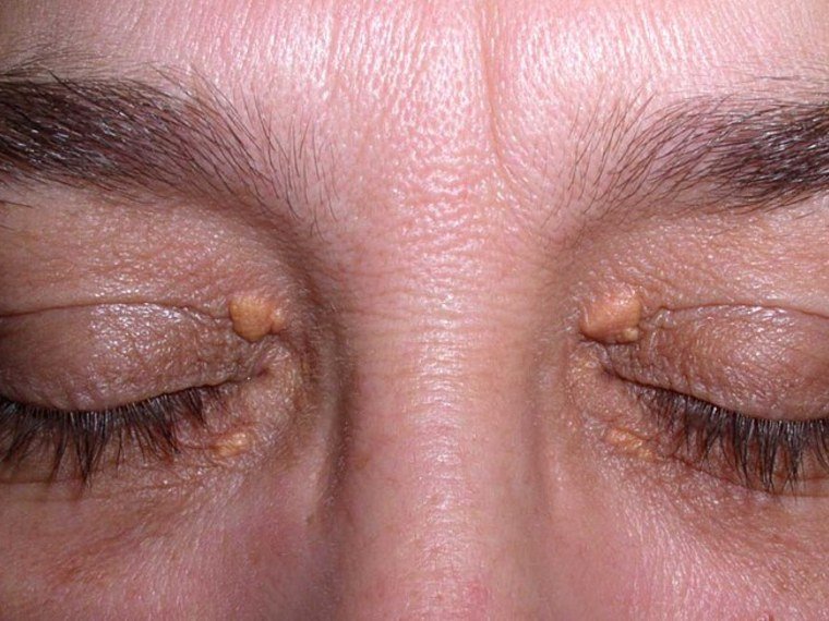 Xantelasma: placas amareladas perto dos olhos