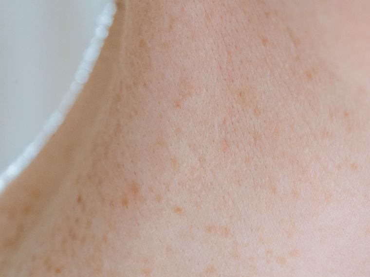 Manchas e textura: pele marcada pelo sol