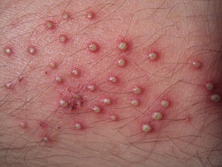 A foliculite: bolinhas com pus em volta de cada pelo