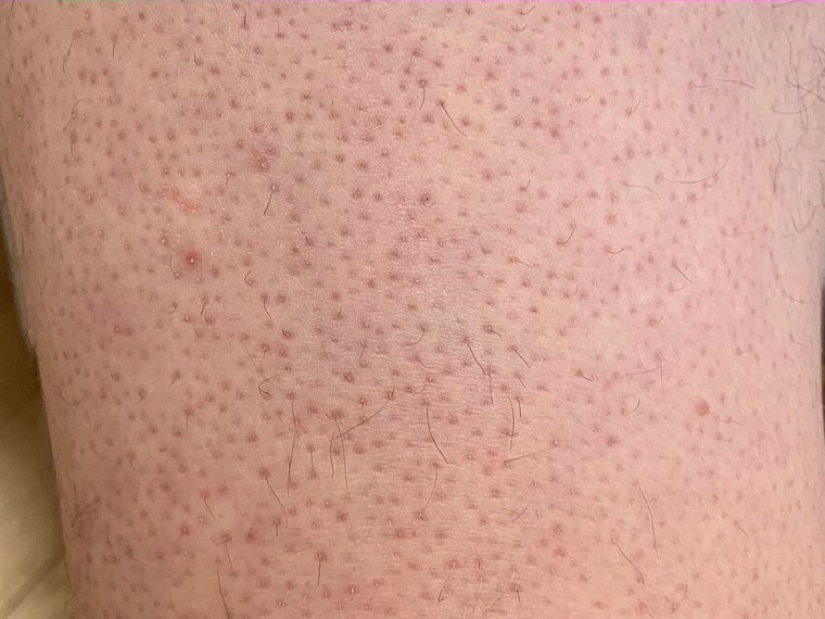 Sem vermelhidão: poros com pequenos tampões de queratina